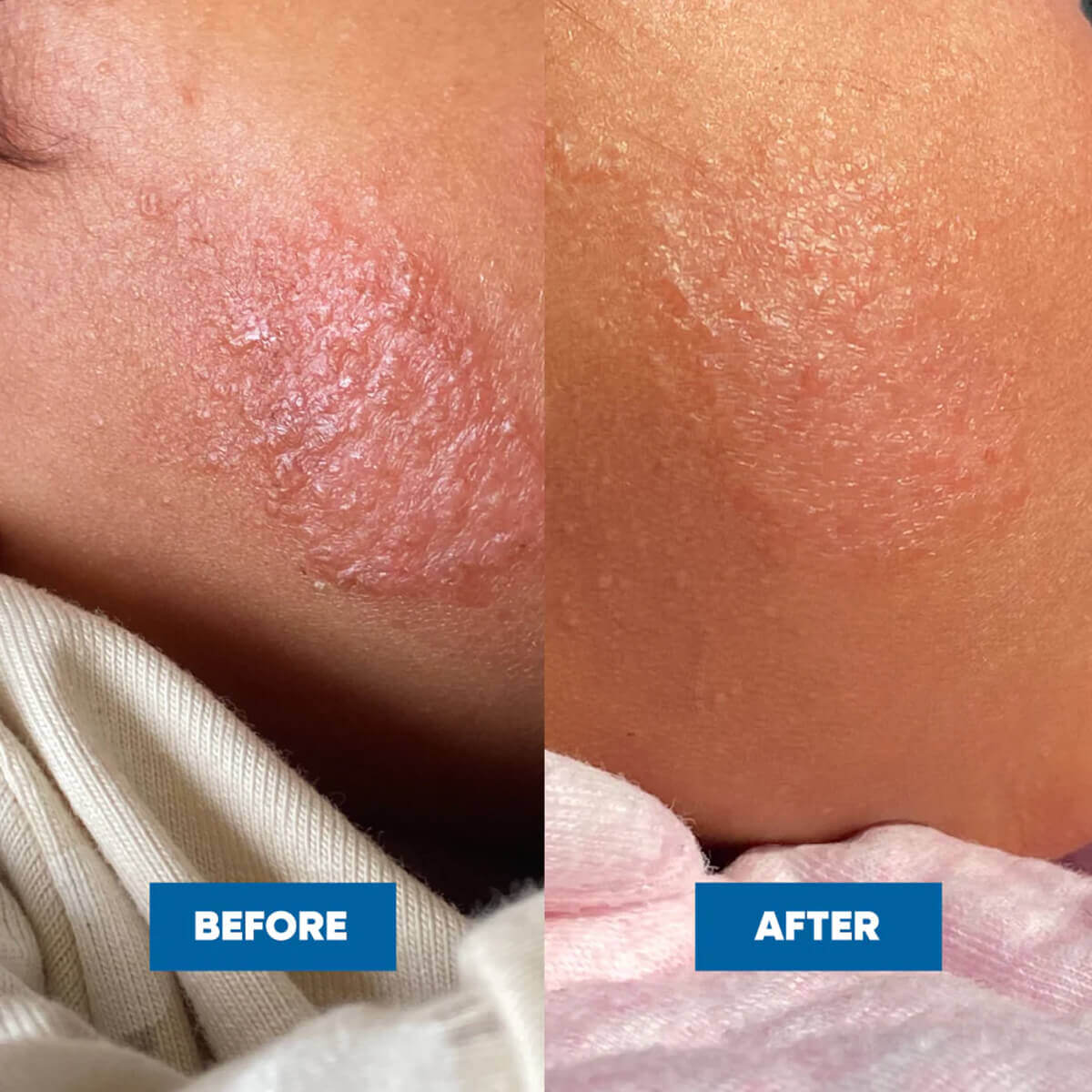 Eczema & Psoriasis Cream - Image 4