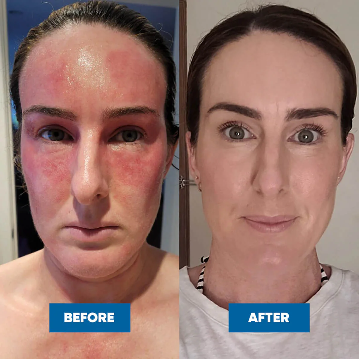 Eczema & Psoriasis Cream - Image 5