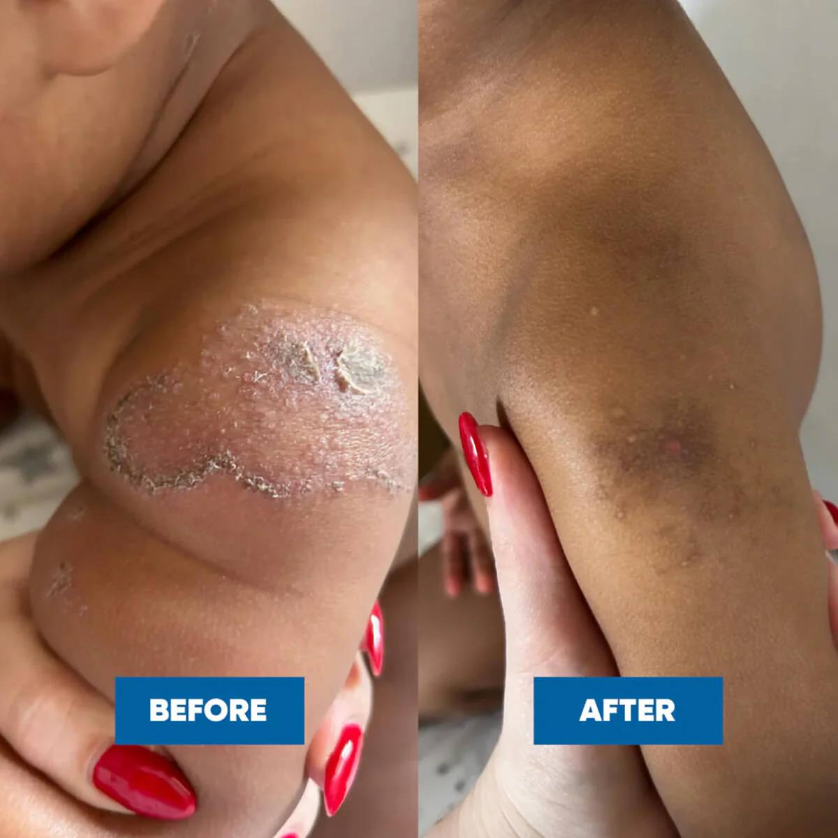 Eczema & Psoriasis Cream - Image 6
