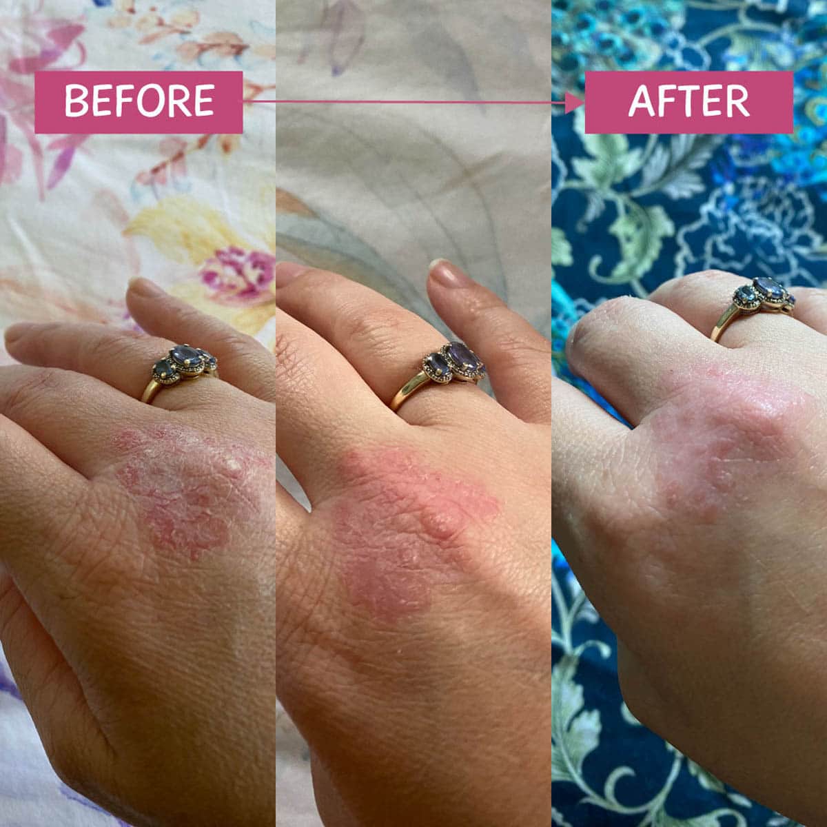 Pink Eczema Cream - Image 4